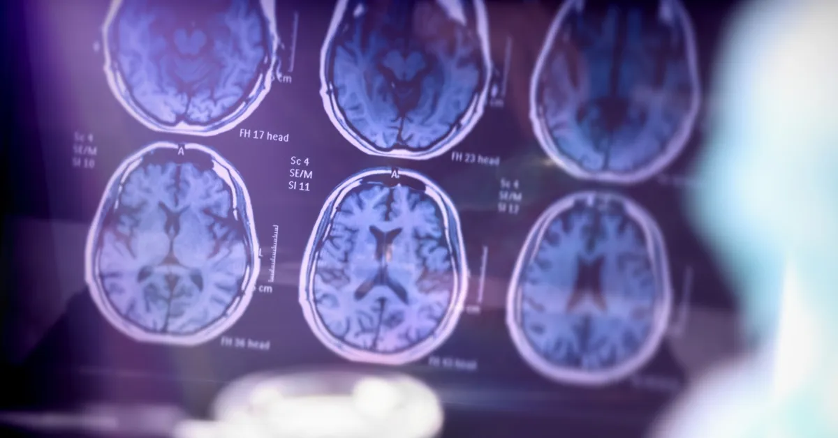 How Long Does Stage 7 Alzheimer's Last?